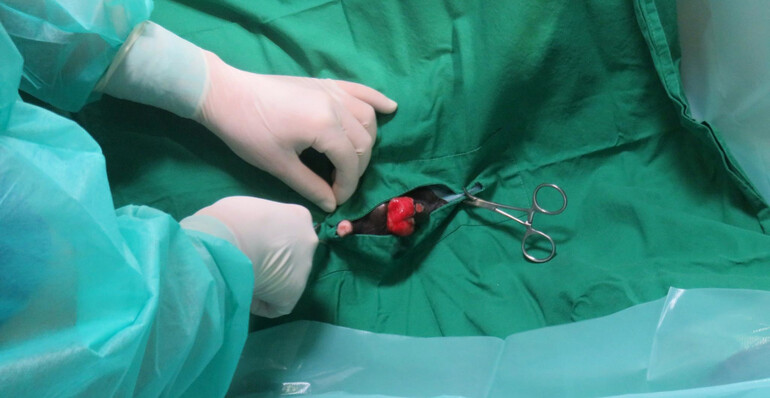 Chirurgie beim Plattenepithelkarzinom